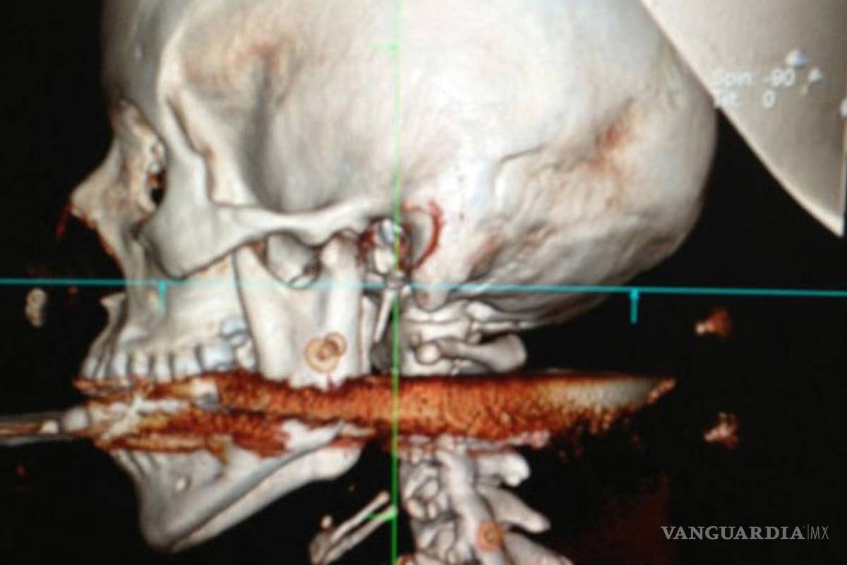 La atravesó un arpón... ¡y sobrevivió!