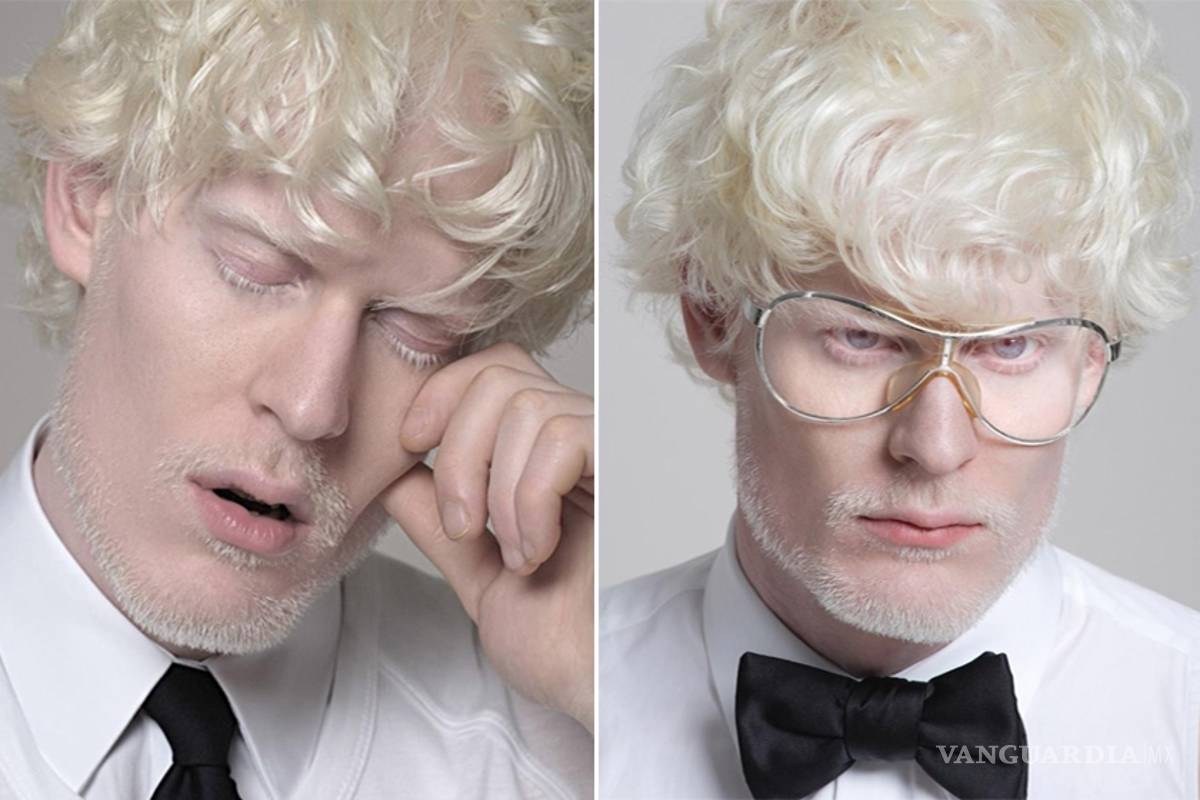 Top Models: Los albinos están de moda