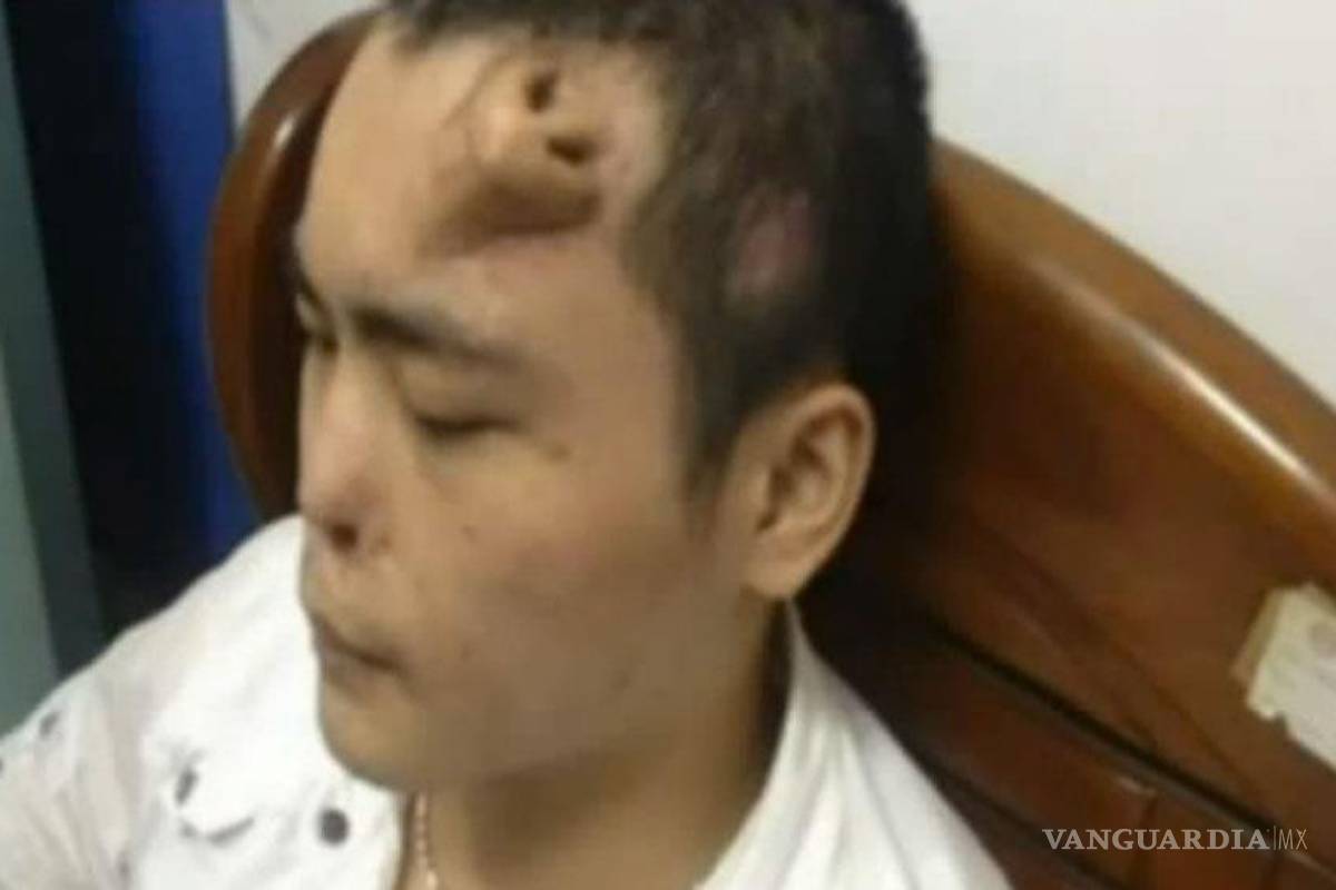 'Crece' nariz en la frente de un joven en China