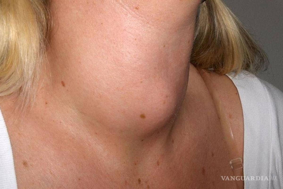 ¿Qué es un nódulo tiroideo?