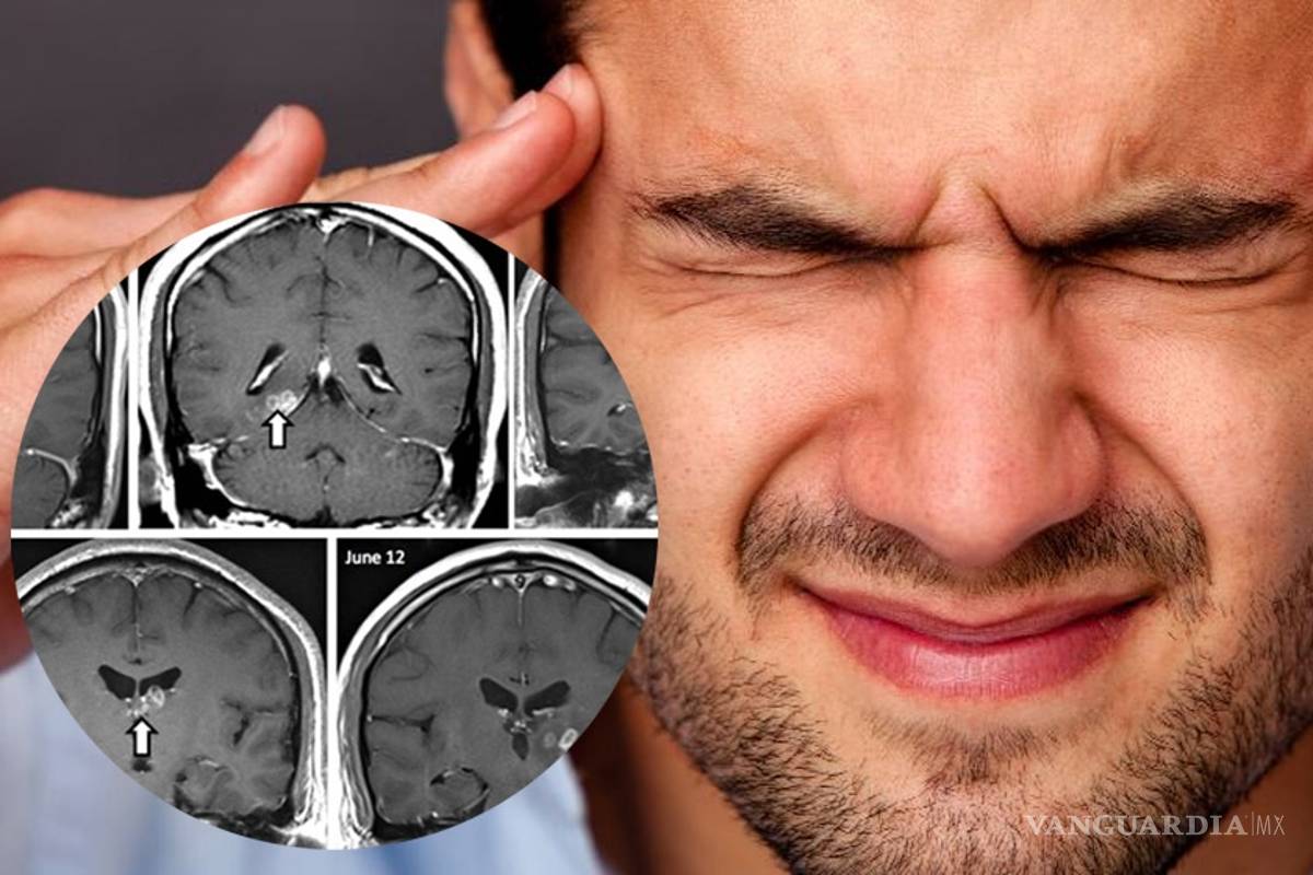 Sufría intensos dolores de cabeza; le hallan un gusano en el cerebro