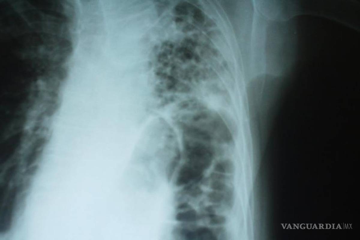 Casi listo tratamiento contra fibrosis pulmonar idiopática