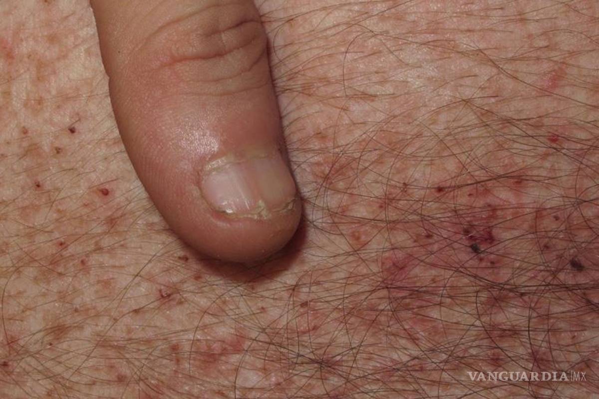 Niños y adolescentes propensos a desarrollar enfermedad de Darier: especialista