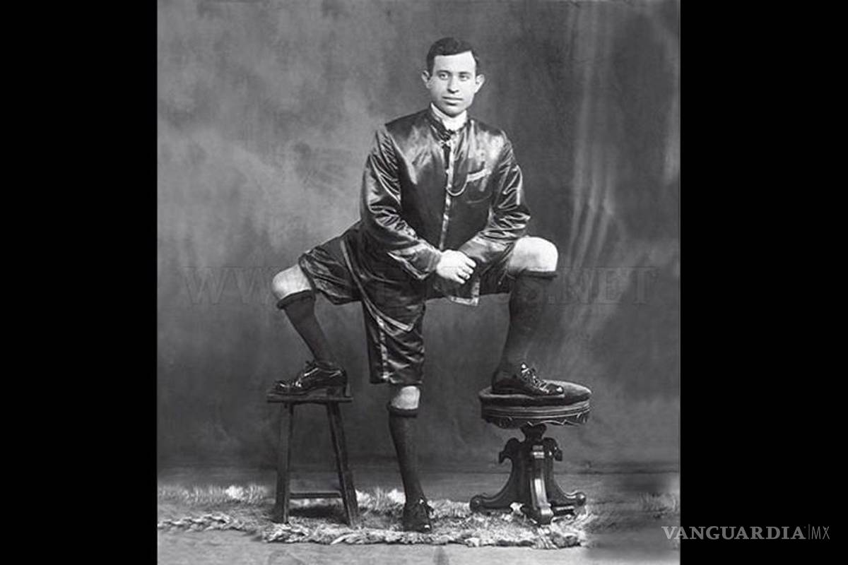 Francesco Lentini, el hombre que nació con tres piernas y dos penes