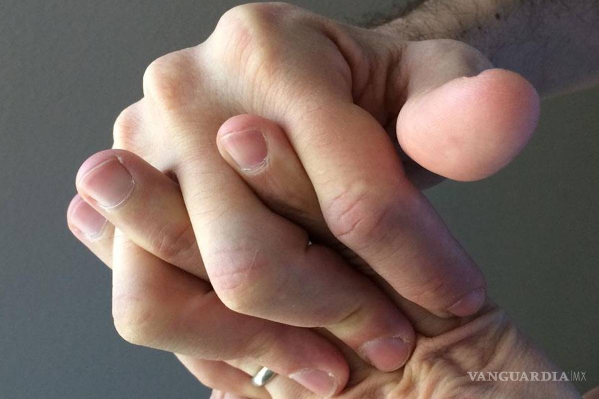 'Tronar' los huesos genera desgaste articular y deformaciones