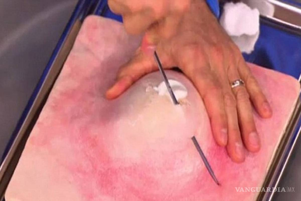 Médico explica cómo reventar un grano sin lastimar la piel