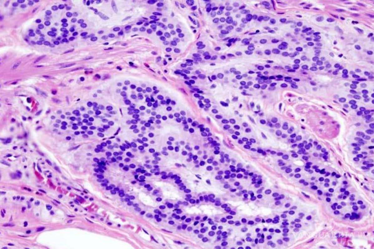 Proteína (DDK-1) permite anticipar el éxito o fracaso de la quimioterapia