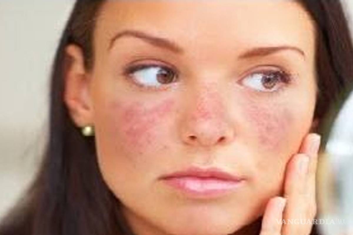 ¿Qué es el Lupus? Signos y síntomas de la enfermedad