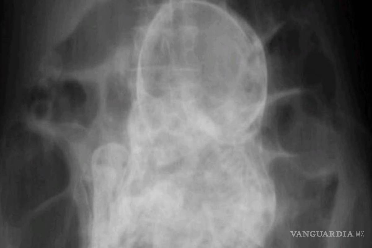 Un feto lleva más de 40 años en cuerpo de mujer