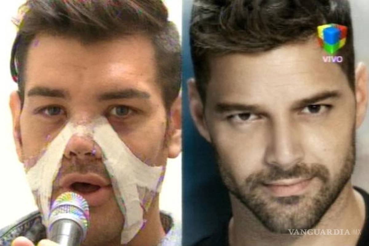 Se somete a múltiples cirugías para parecerse a Ricky Martin