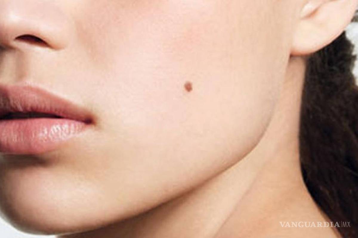 Lunares, clave en la prevención de cáncer de piel