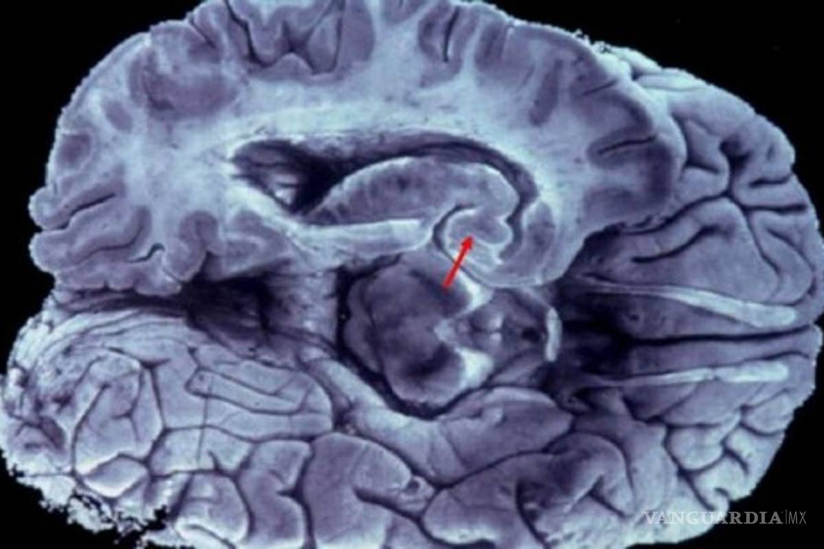 Se puede diagnosticar Alzheimer hasta con 10 años de anticipación