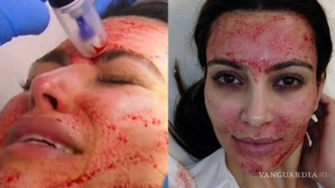 $!'Facial de vampiro' expone a las personas a contraer VIH