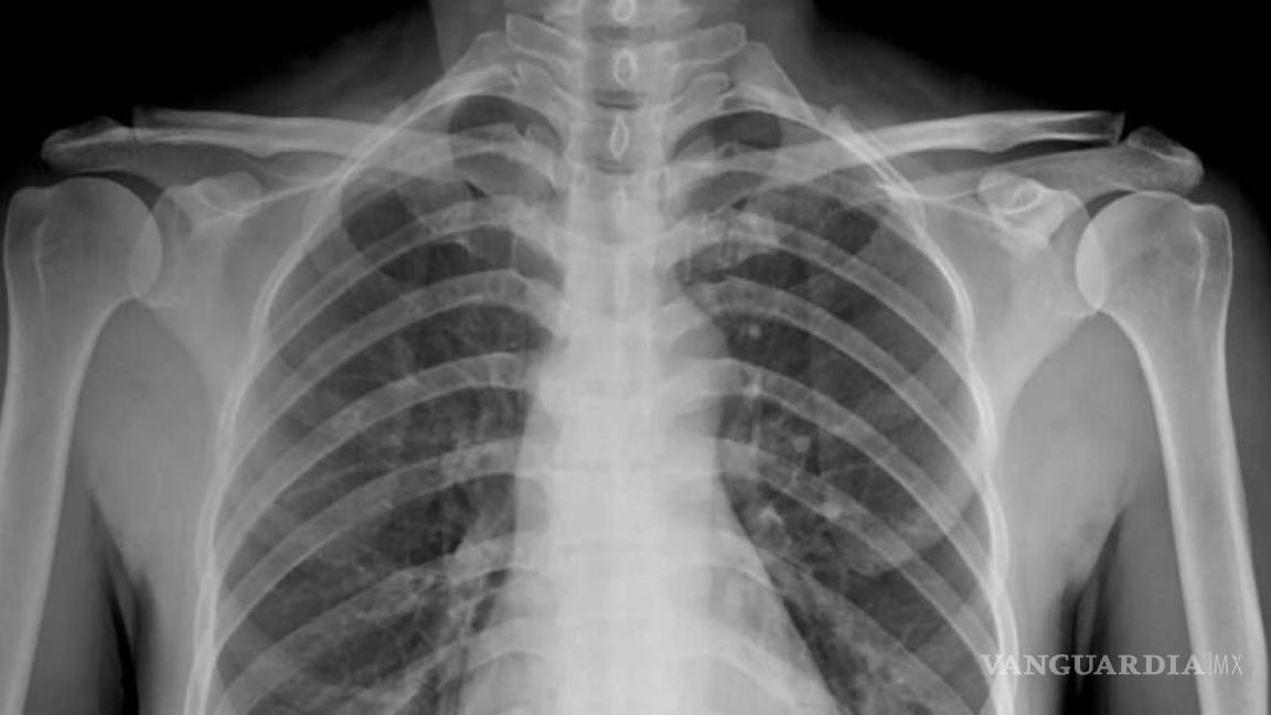 Pulmones de enfermos de COVID-19 quedan más dañados que los de fumadores, alertan