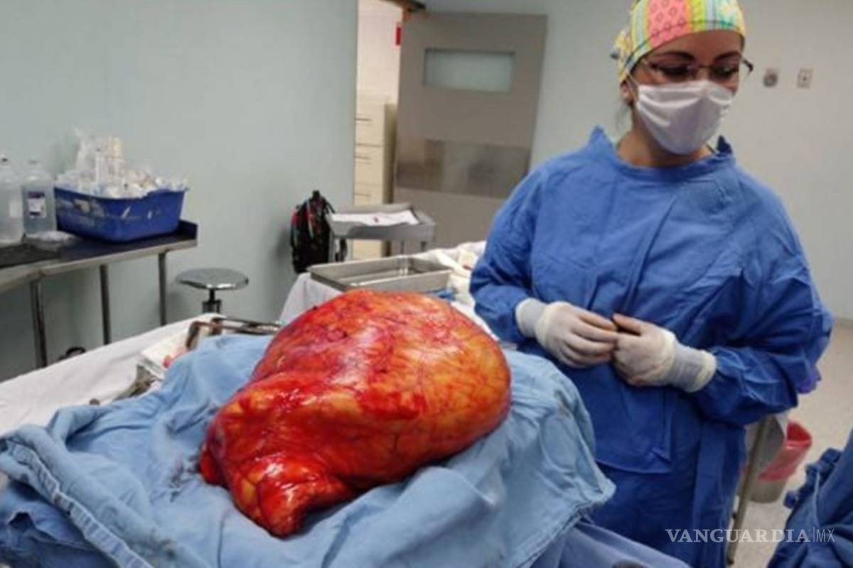 Extirpan tumor abdominal de 17 kilos a una mujer en un IMSS