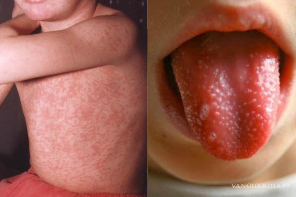 ¿Cuáles son los síntomas de la Escarlatina, enfermedad afecta principalmente a niños y reporta casos en Hidalgo, Nuevo León y CDMX?