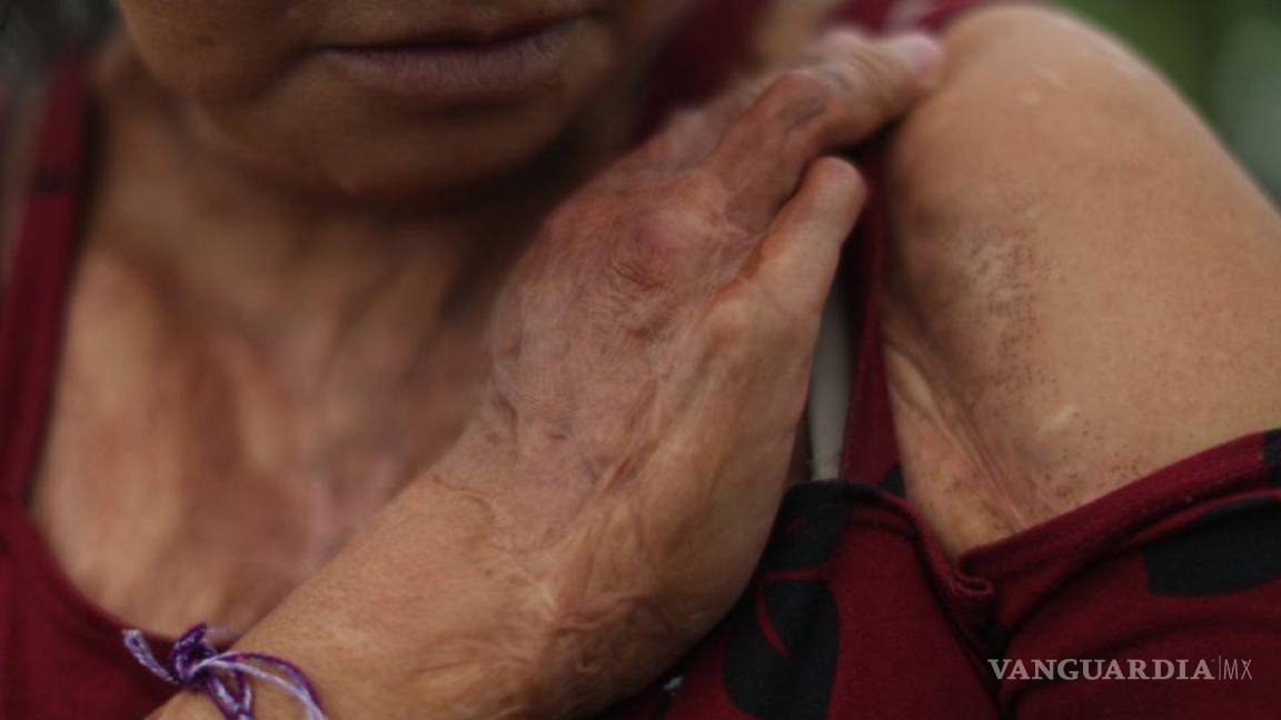 ¿Cuántas mujeres son víctimas de ataques con ácido en México?