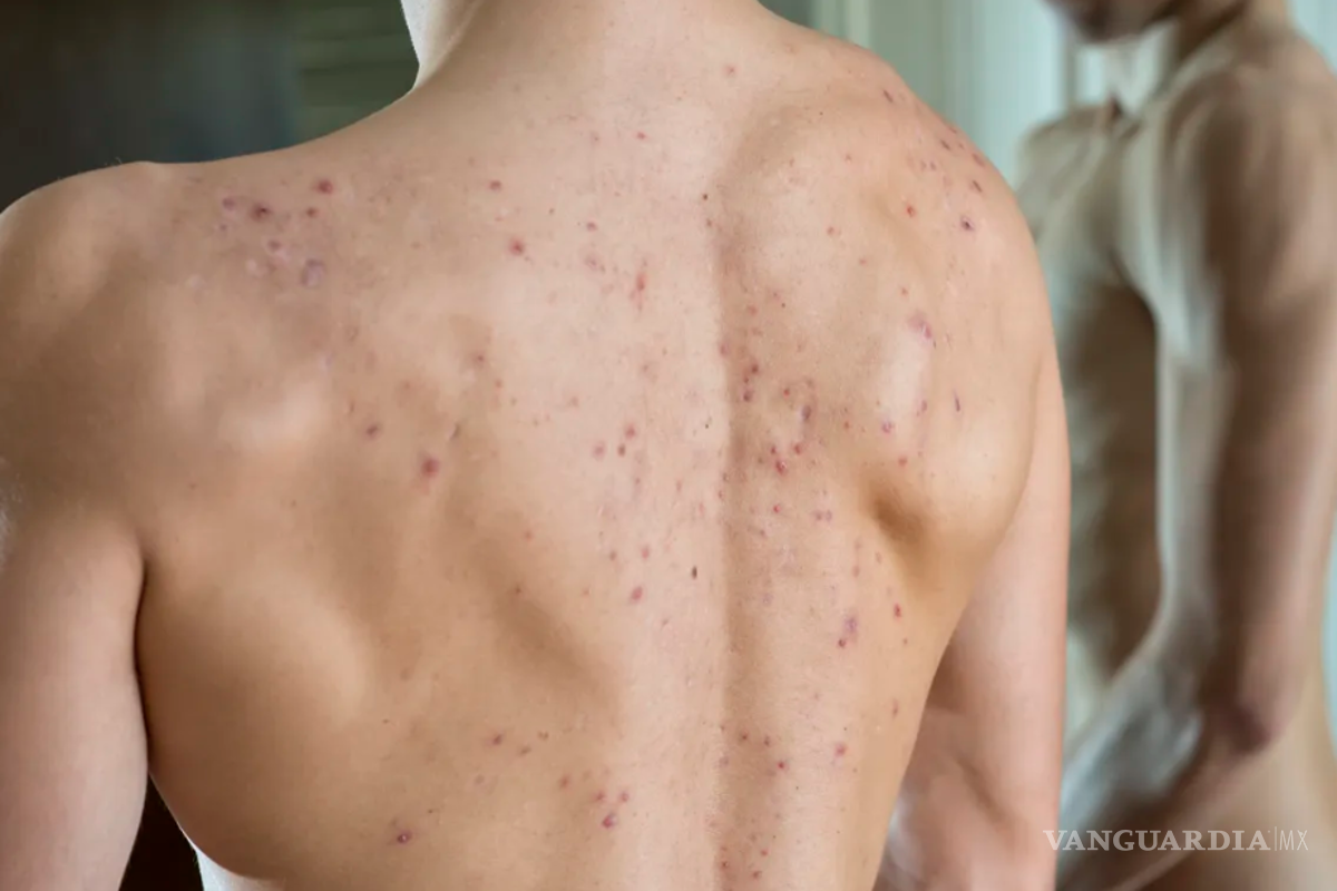 $!El adapaleno mejora la apariencia de la piel y evita la acumulación de células muertas.