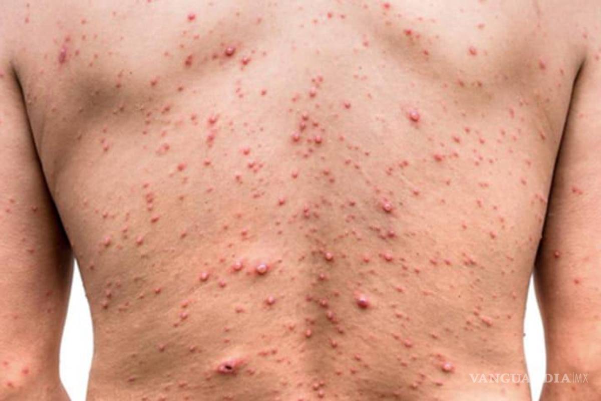 Detectan caso sospechoso de viruela símica en IMSS de Torreón