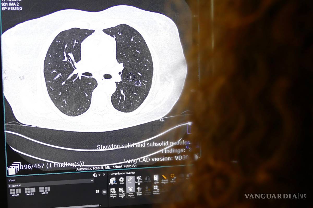$!Imagen de una tomografía computarizada pulmonar en la que la IA muestra la presencia de un nódulo pulmonar sospechoso.