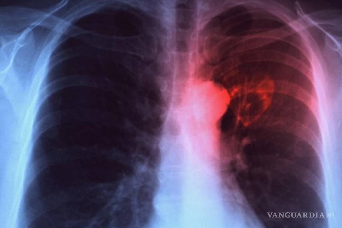 Tuberculosis provoca tantas muertes a nivel mundial como el Sida, alerta la OMS