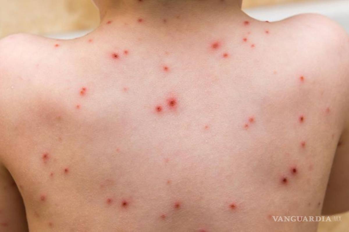 Reportan segundo caso confirmado de viruela símica en Coahuila