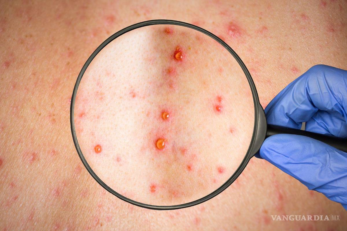 Suben a 21 los casos de viruela del mono registrados en Nuevo León