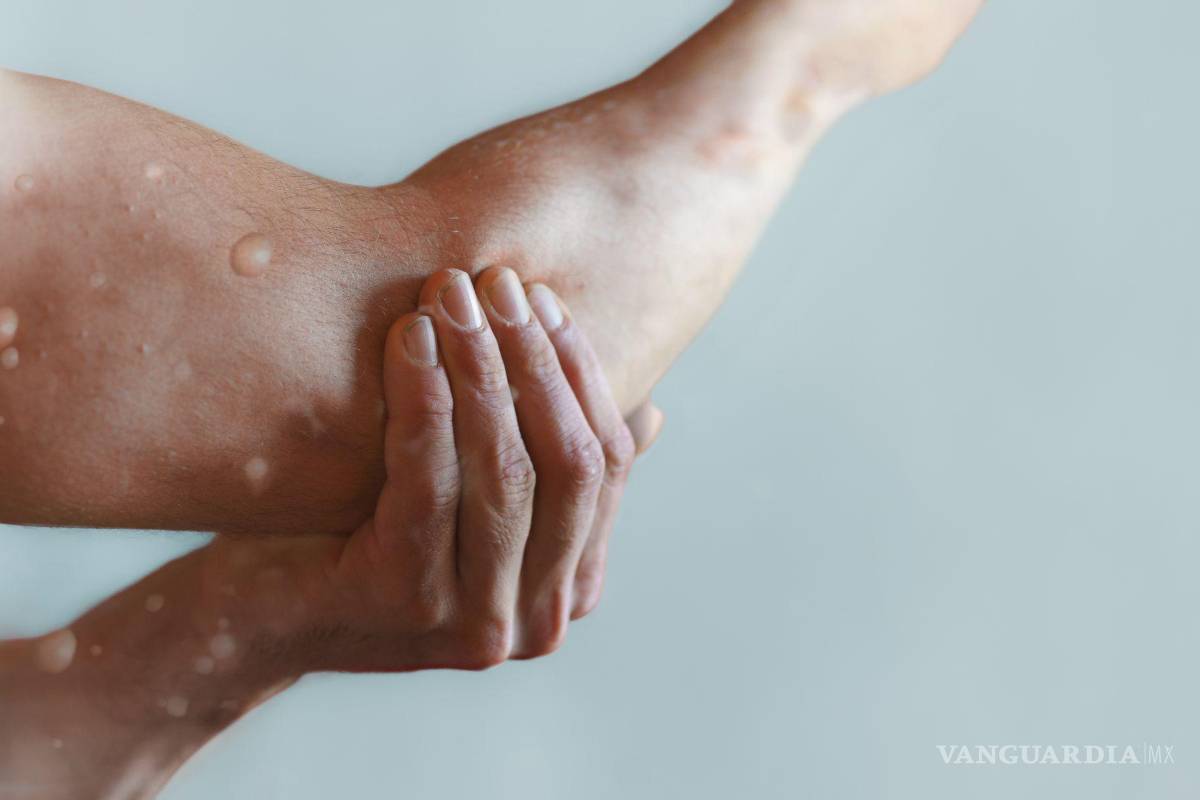 Suman 50 probables casos de viruela del mono en Coahuila; sólo 11 fueron confirmados