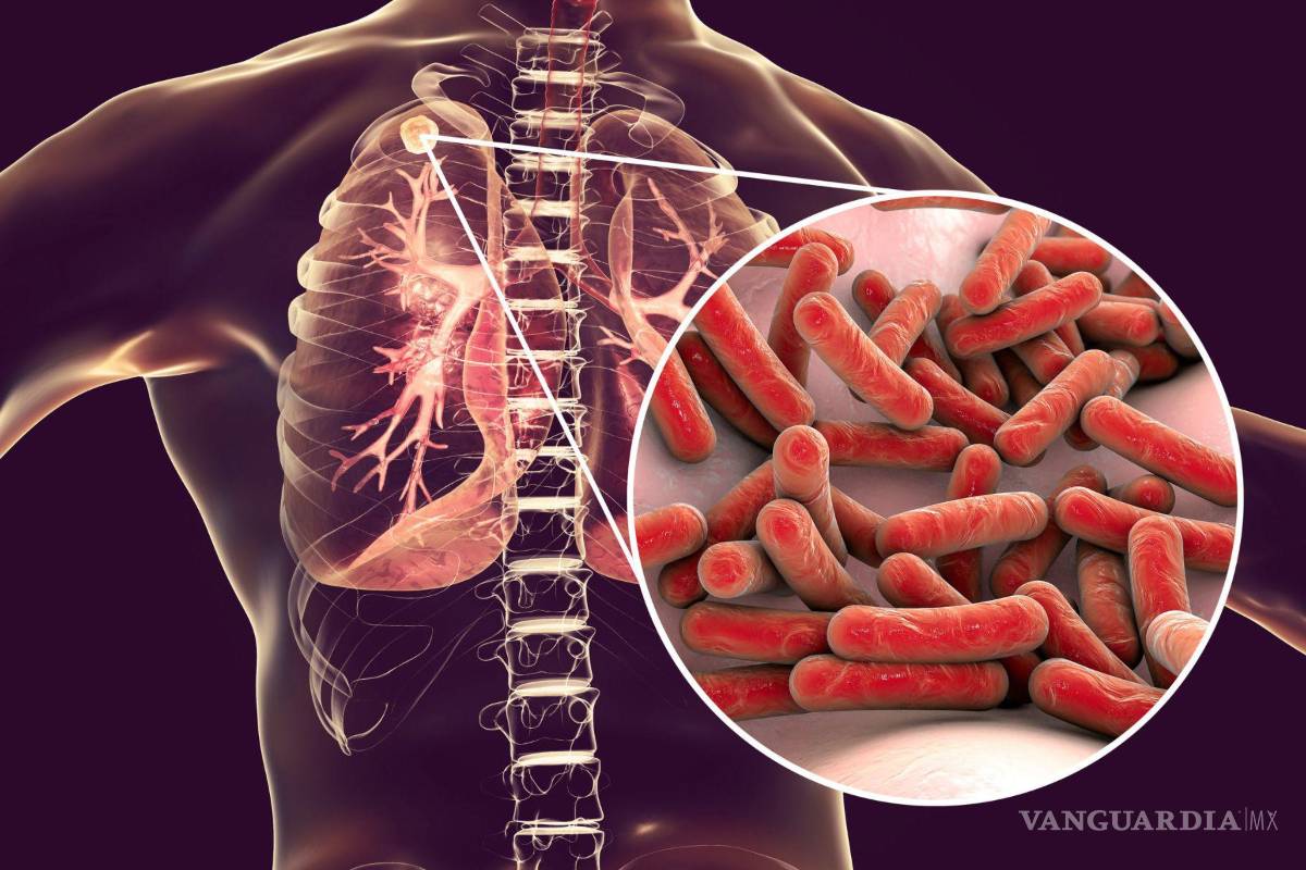 Al alza contagios de tuberculosisen Coahuila; reportan desabasto en vacunas