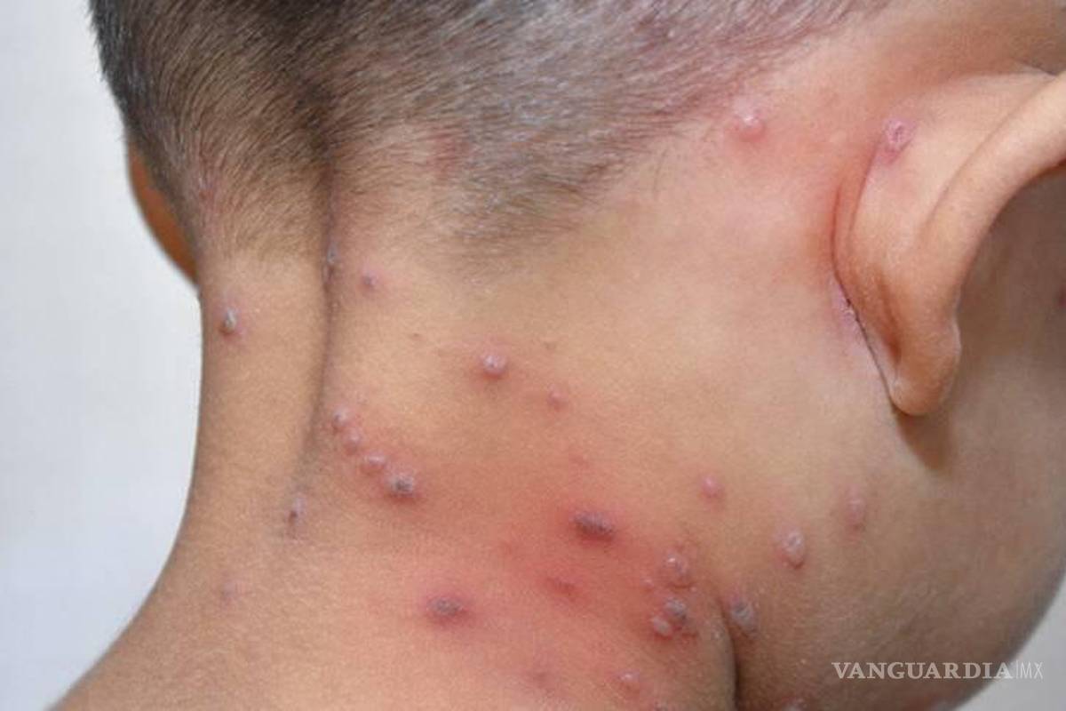 $!La varicela puede resultar contagiosa para aquellas personas que no hayan sufrido la enfermedad o que no se hayan vacunado. El síntoma más característico es un sarpullido con picazón similar a una ampolla en la piel.