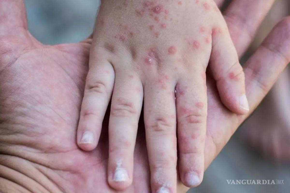 Saltillo: Secretaría de Salud dictaminará posible brote de coxsackie en el Colegio Nicolás Bravo