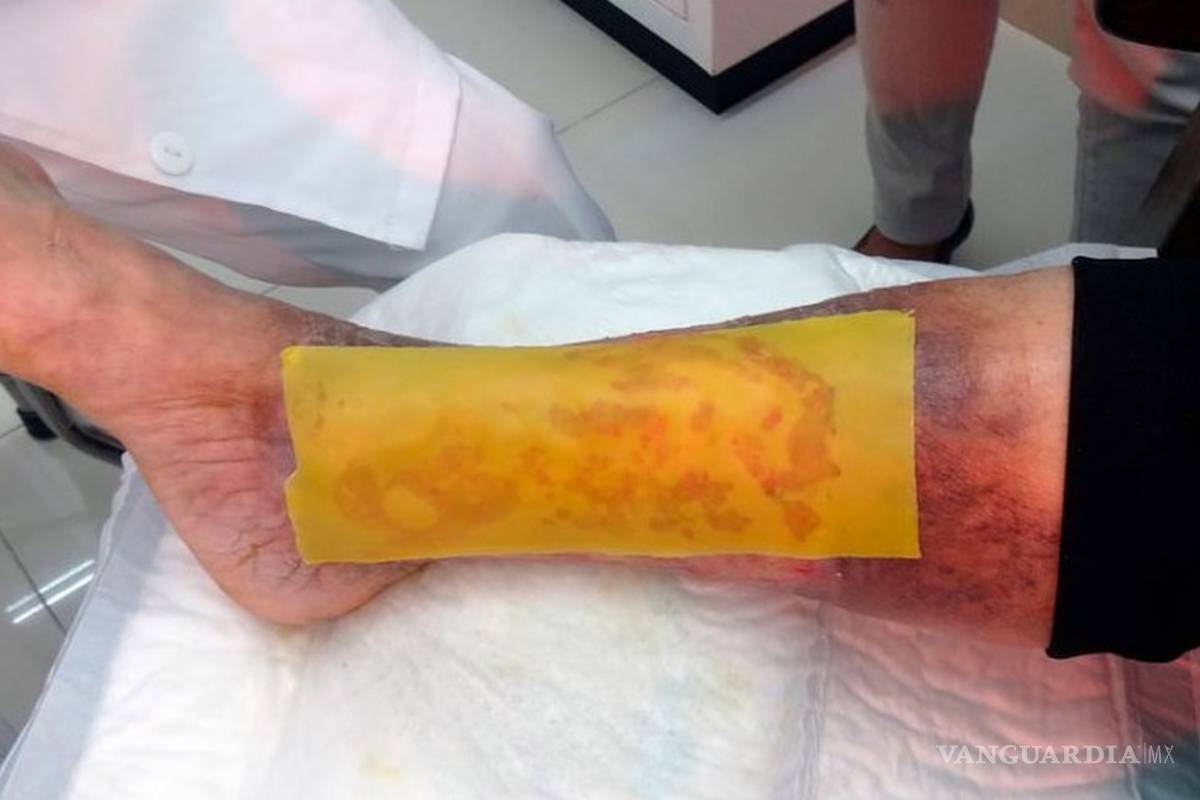 Parche de miel evita amputaciones en gente con diabetes