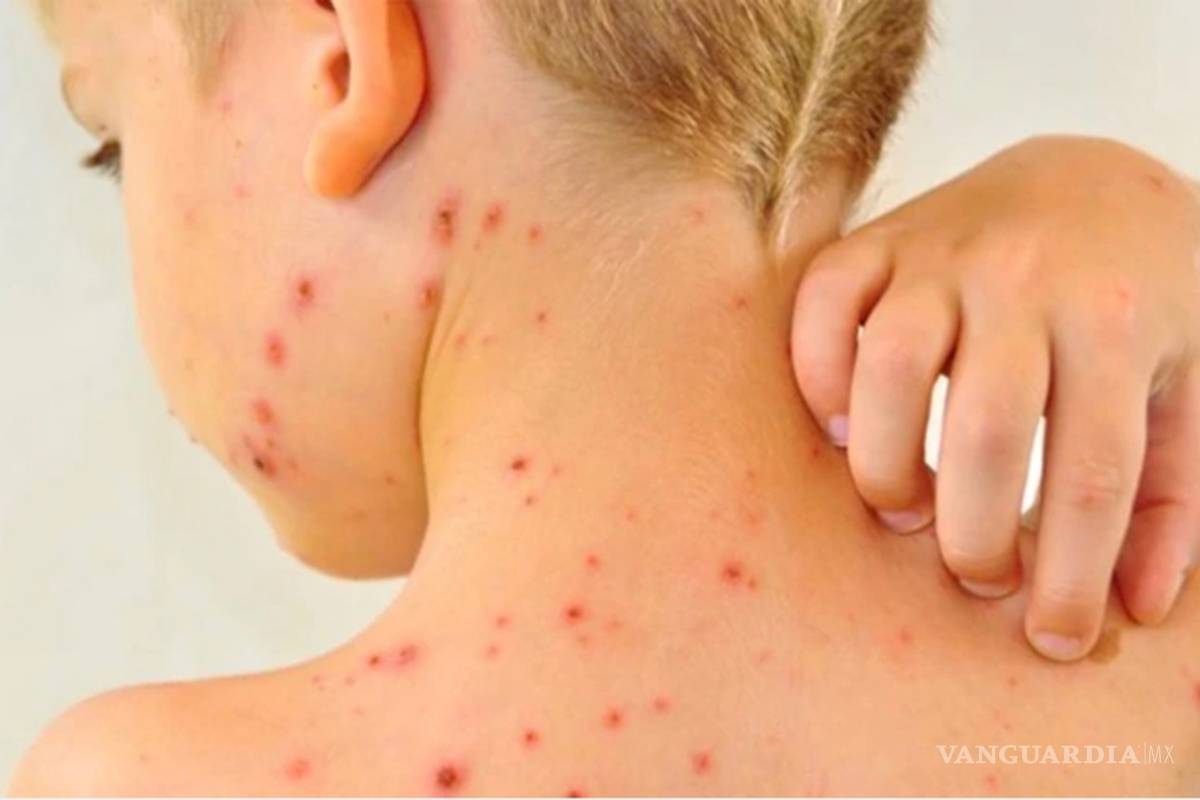 En México son confirmados 515 casos de sarampión