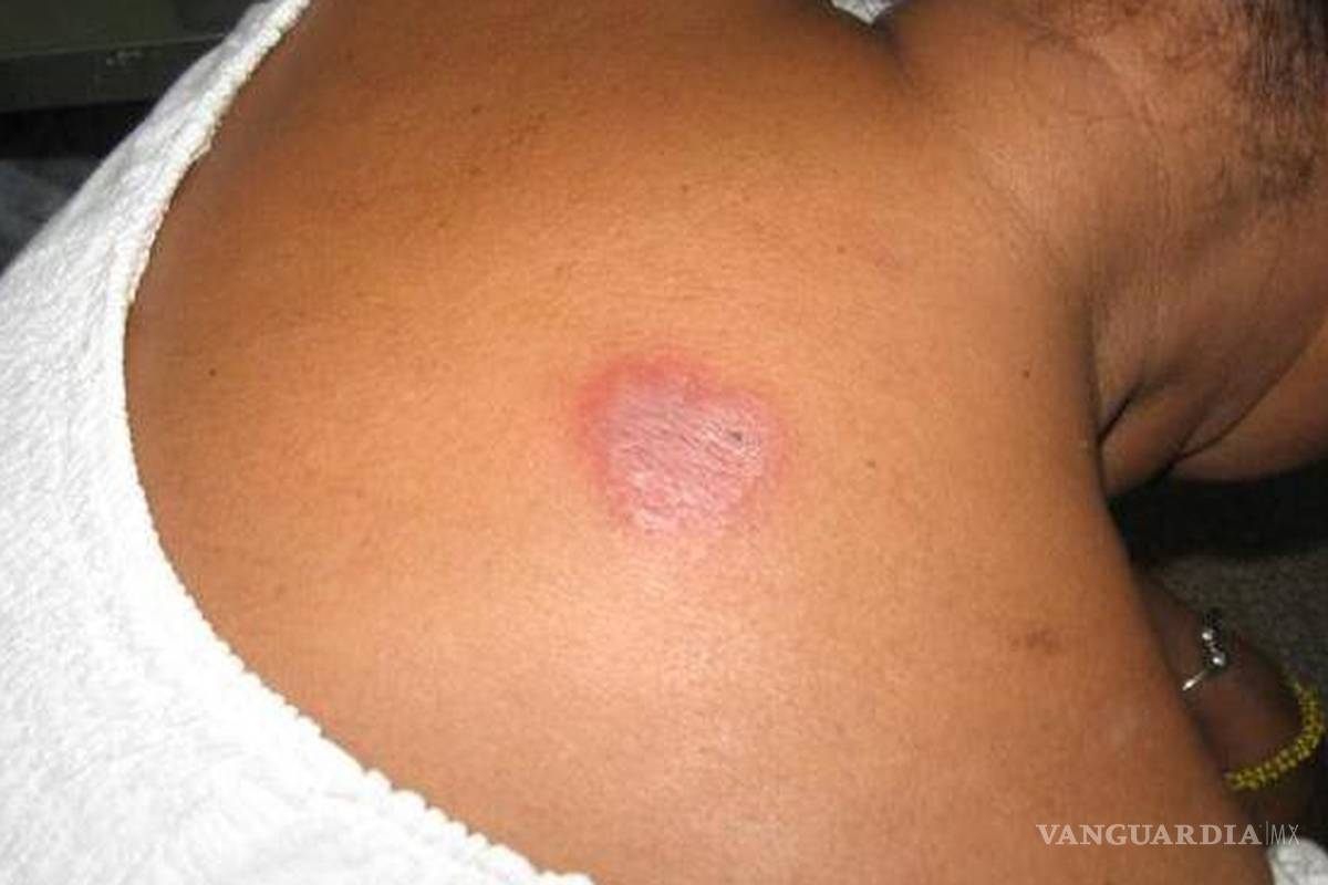 Piedras Negras sin casos de Lepra, reportan autoridades sanitarias