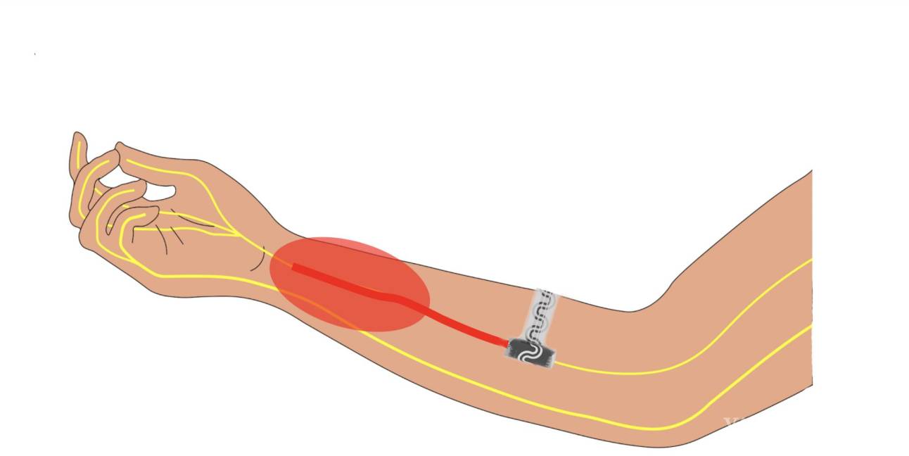 $!Ilustración del implante dentro de un brazo. El óvalo rojo indica dolor. El dispositivo envuelve el nervio periférico para silenciar las señales al cerebro.