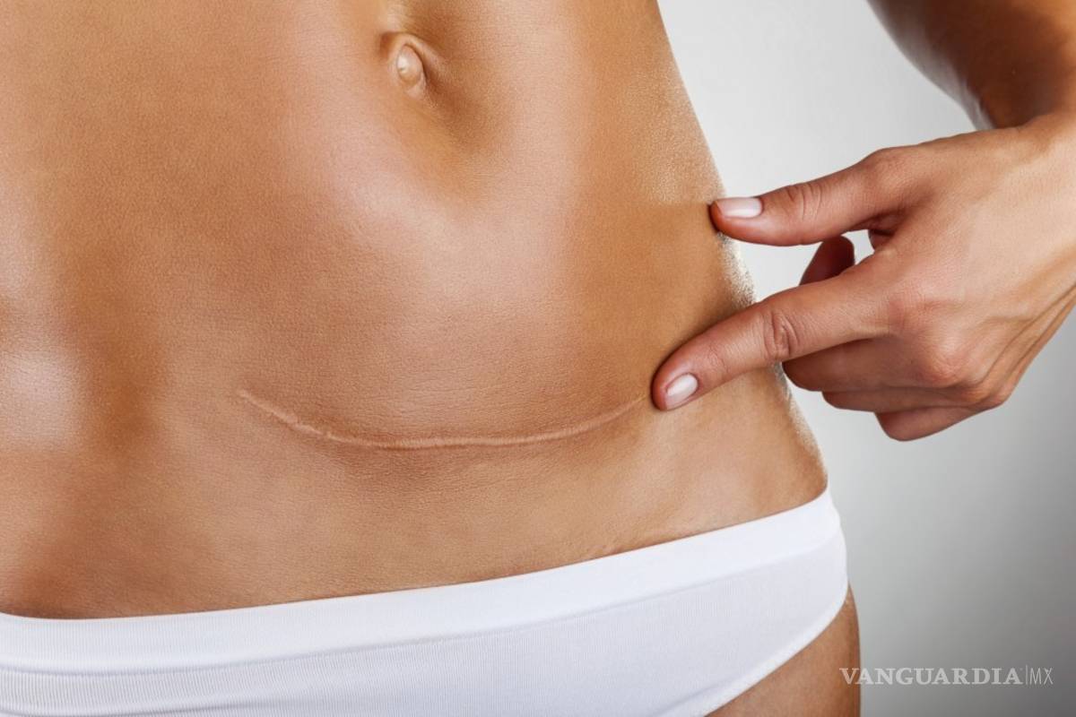 Las cesáreas, tres veces más peligrosas que el parto natural