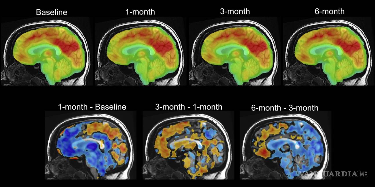 $!Serie de imágenes de escaneo cerebral PET que muestran cambios en la paciente Emily Hollenbeck con terapia de estimulación cerebral profunda.