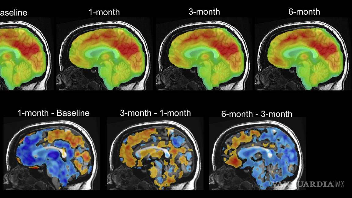 $!Serie de imágenes de escaneo cerebral PET que muestran cambios en la paciente Emily Hollenbeck con terapia de estimulación cerebral profunda.