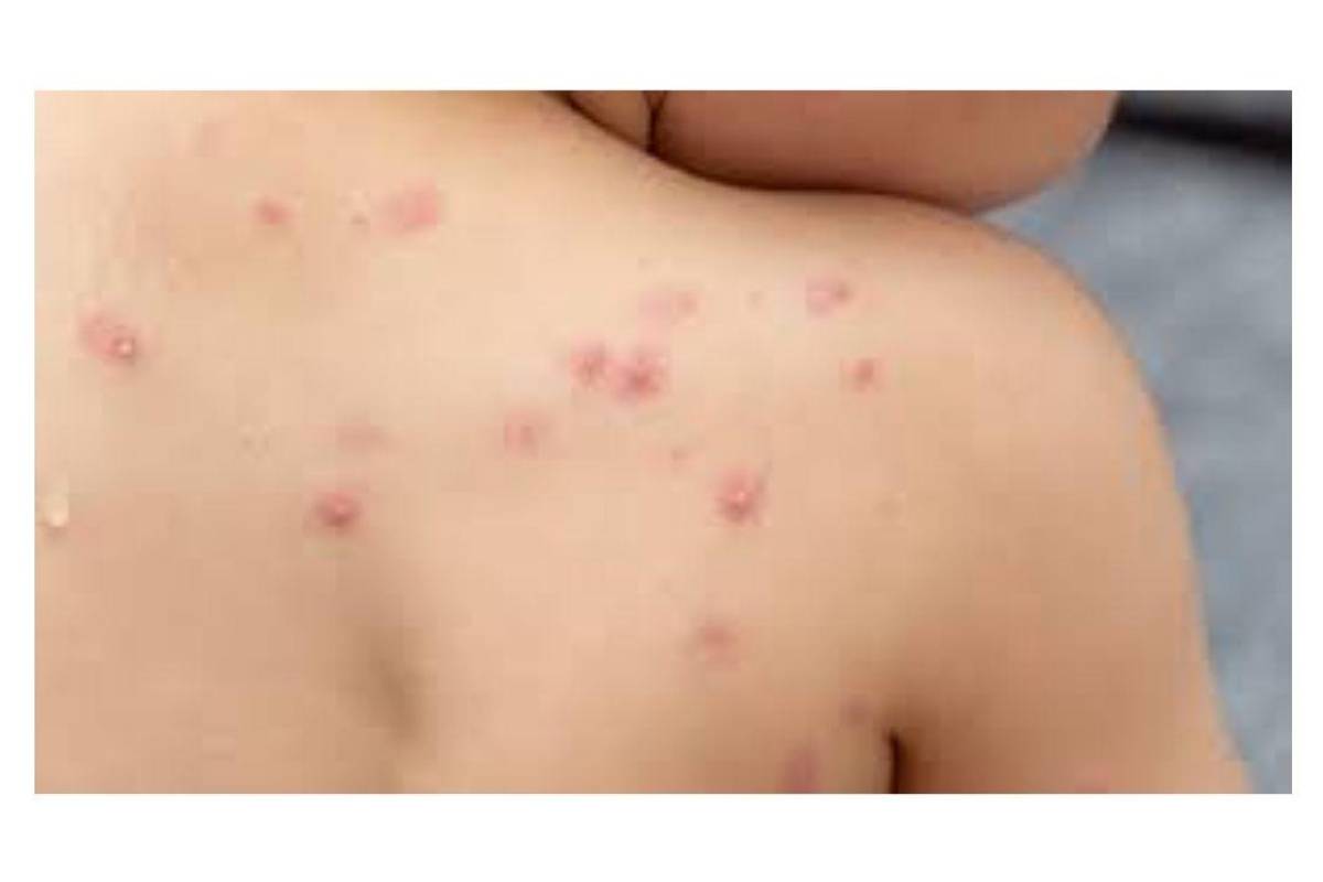 Ronda a Coahuila viruela del mono: confirman primer paciente en Nuevo León