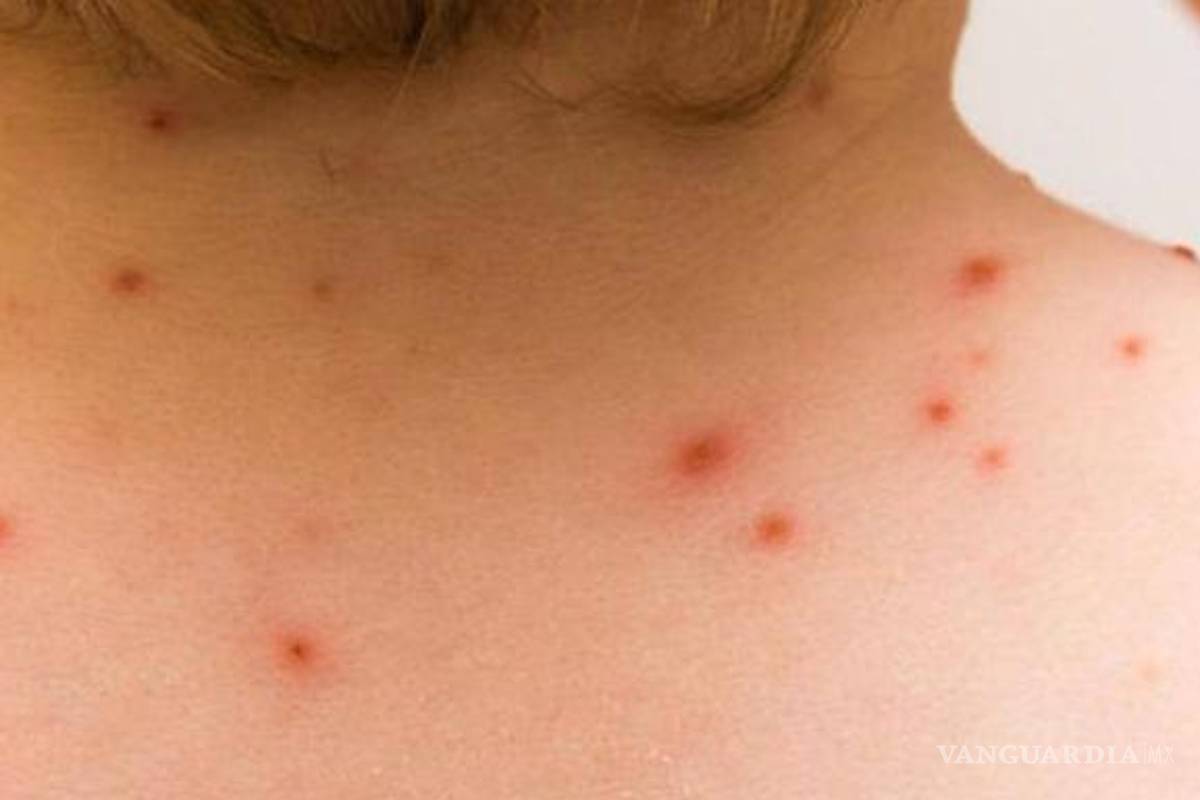 Reportan 3 nuevos casos de viruela de mono