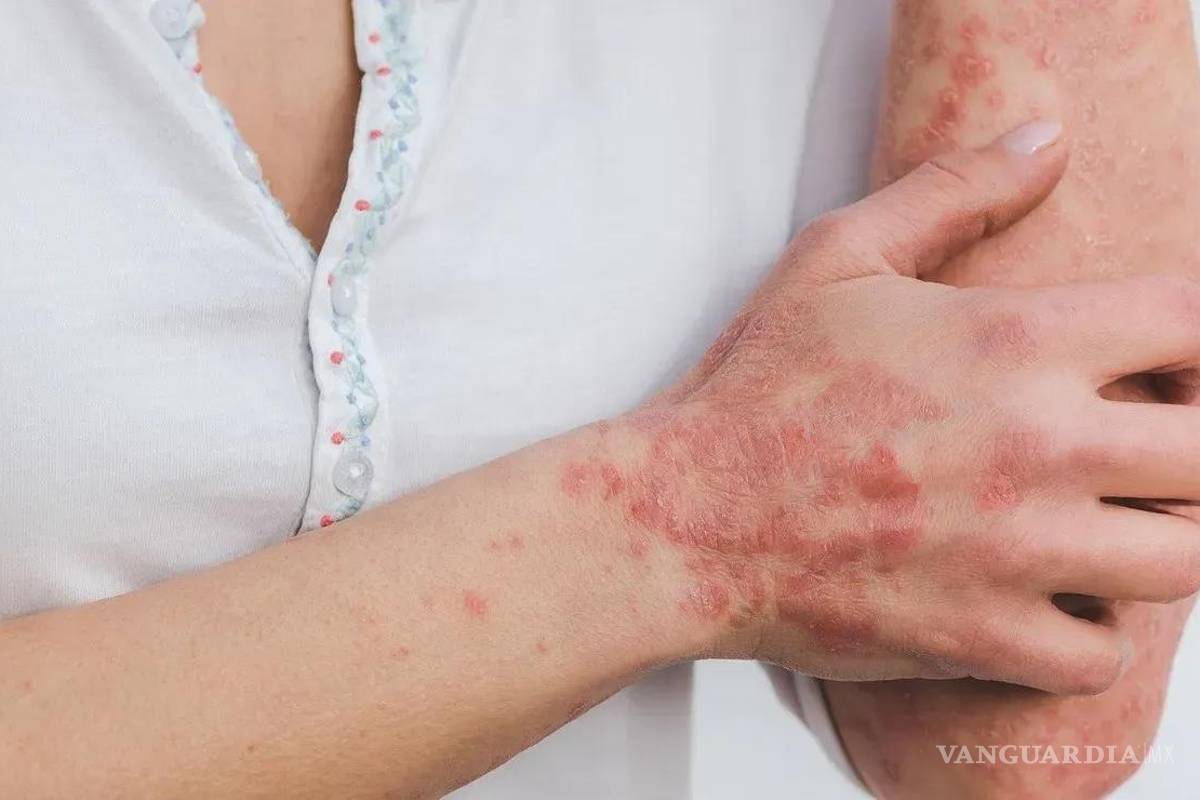 Alerta la Secretaría de Salud por aumento de casos de lepra en México; vigila a 28 estados de la República