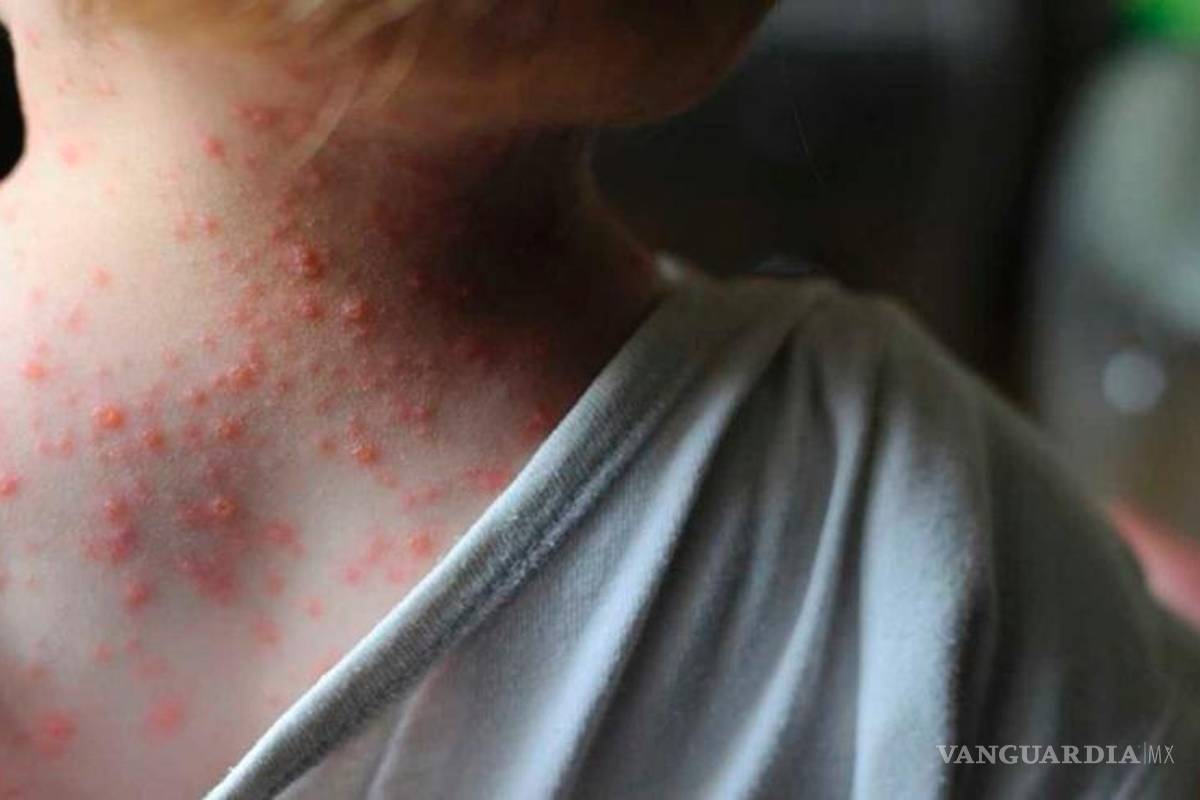 Ve OMS inusual brote de viruela del mono