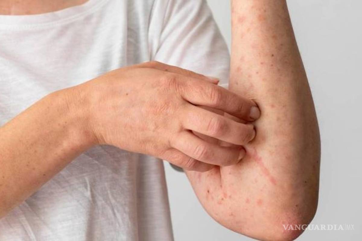 Chiapas reporta su primer caso de viruela de mono