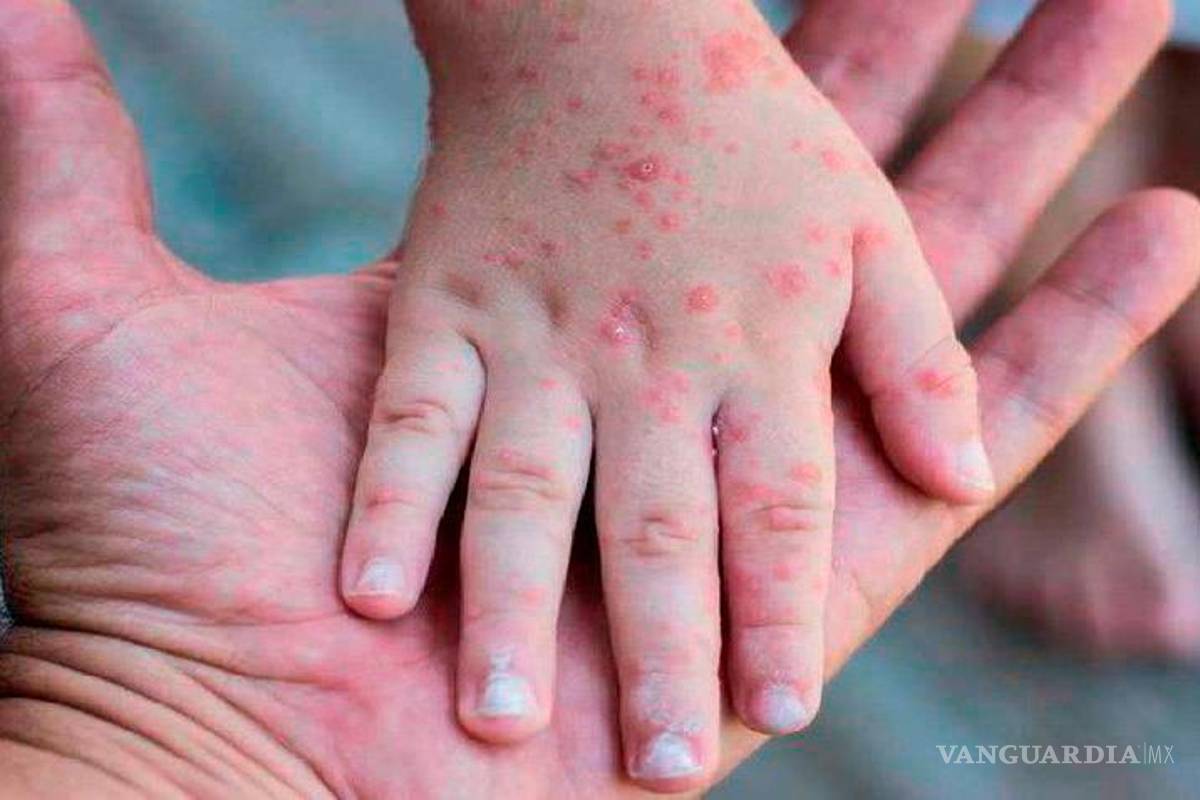 OMS tendrá reunión de emergencia por viruela del mono; ya son más de 6 mil casos en el mundo