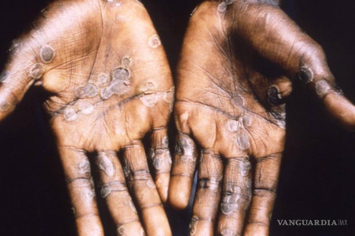 Confirma Salud 91 casos de viruela del mono en México