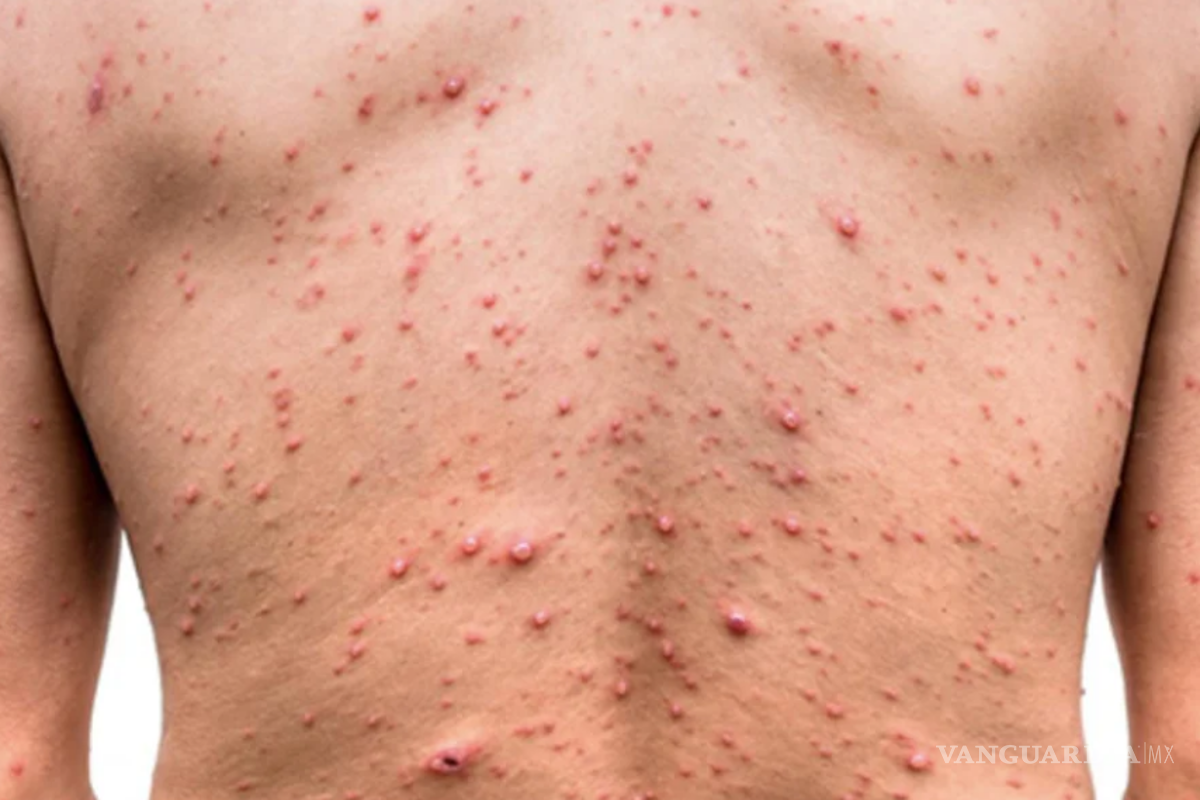 Preocupa a comunidad LGBT+ viruela símica tras caso positivo en Vallarta