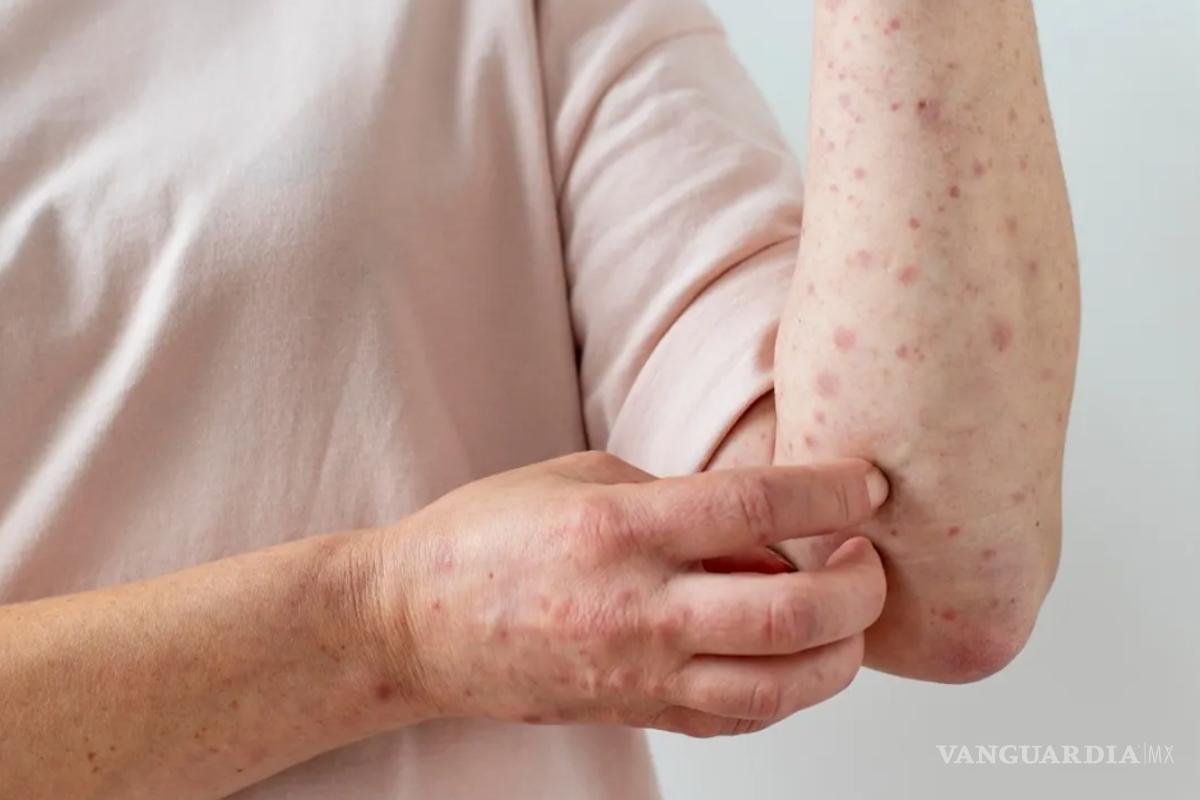 ¿Cuál es la mejor manera de deshacerse del acné corporal?