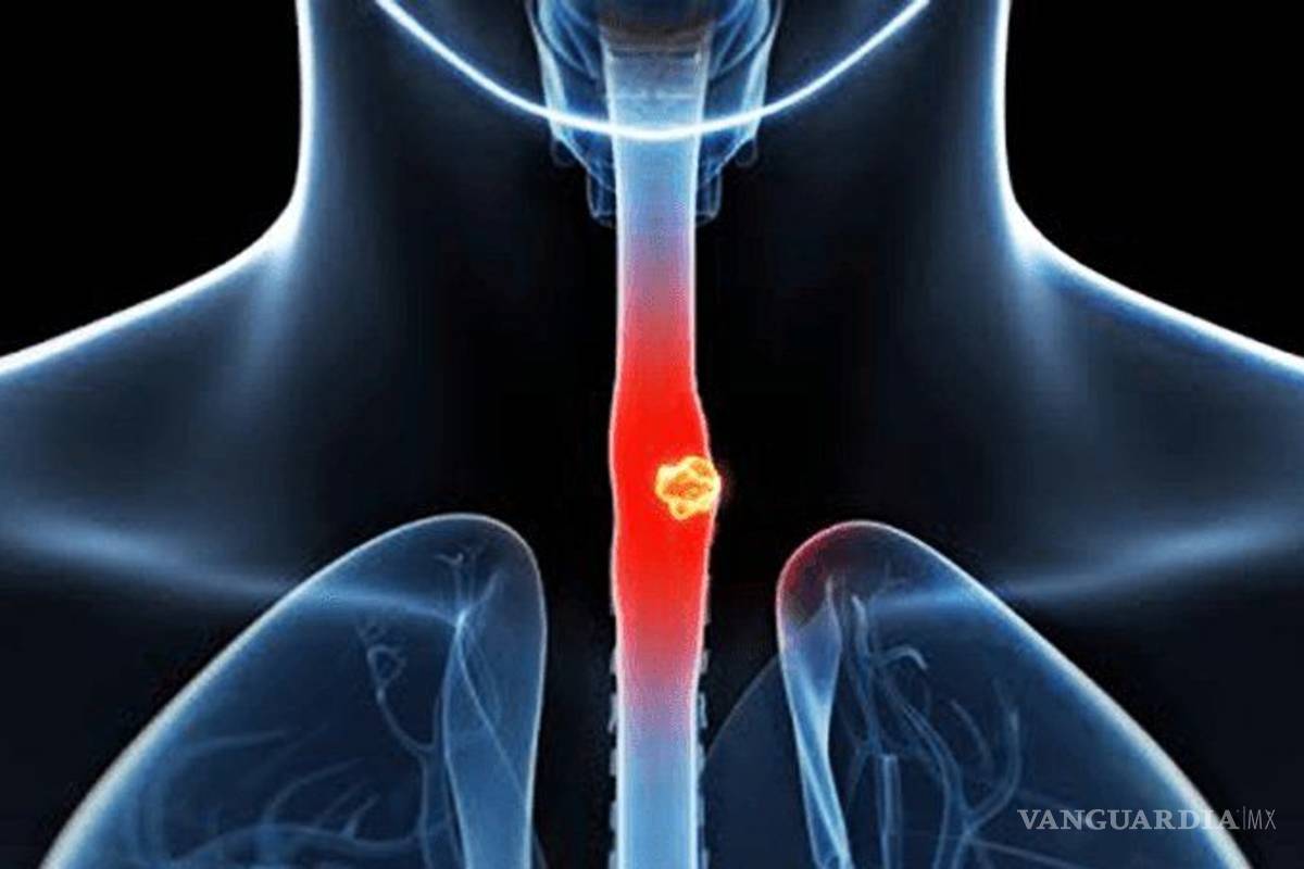 7 señales del cáncer de esófago