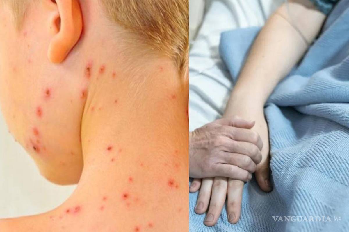 Sarampión y Síndrome de Guillain Barré acechan en México... ¿Qué se sabe de los casos confirmados y cuáles son los síntomas de estos males?