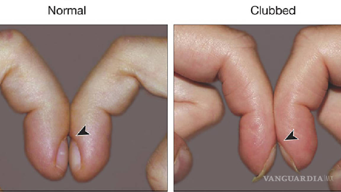 'Dedos hipocráticos': una forma en la que tus manos te avisan que algo anda mal